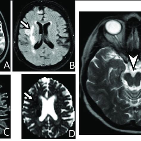 (PDF) MRI of Wallerian Degeneration in the Brainstem: A Pictorial Essay