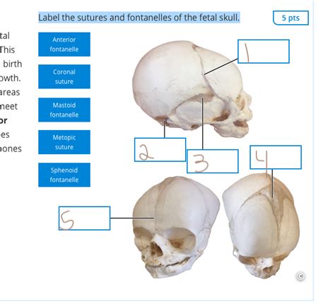 Solved Label the sutures and fontanelles of the fetal skull. | Chegg.com