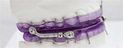 Herbst Appliance | Orthodontics with a Herbst Dental Appliance ...