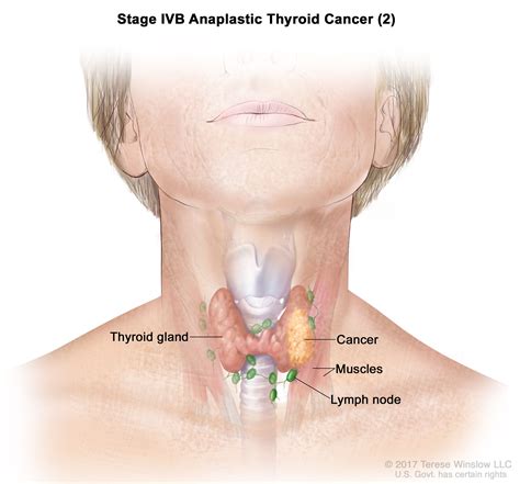 Buzz Feed: 2 Swollen Lymph Nodes In Neck