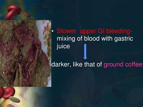 Aetiology of upper gi bleed