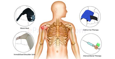 Shoulder Instability Or Dislocations • Stephane Andre