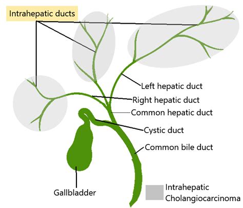 Intrahepatic cholangiocarcinoma: treatment, surgery | Dr. Nikhil Agrawal