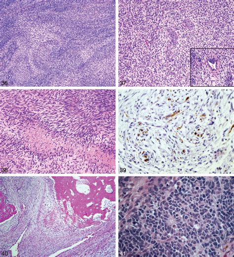 Neurogenic Tumors of Soft Tissue | Semantic Scholar