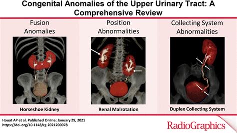 Congenital Anomalies of the Upper Urinary Tract: A Comprehensive Review | RadioGraphics