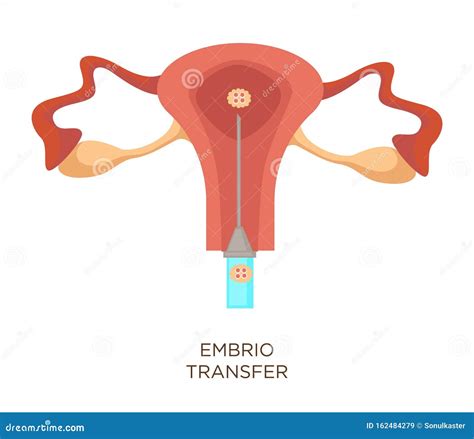 IVF Embryo Transfer Royalty-Free Stock Image | CartoonDealer.com #73449832