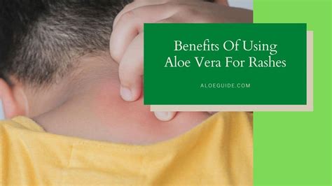 Aloe Vera For Rashes [Research, Efficacy and more] | Aloe Guide