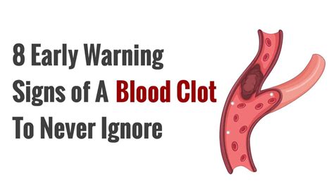 8 Early Warning Signs of A Blood Clot to Never Ignore