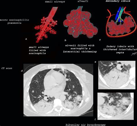 Diagrams Eosinophilic Pneumonia | Lungs