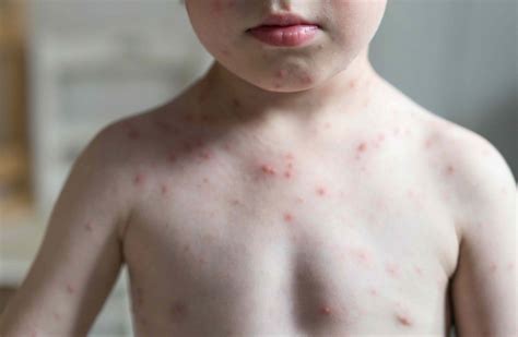 CPD: Key questions on chickenpox - Pulse Today