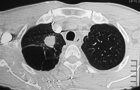 CT thorax (lung window) showing spiculated pulmonary nodule at the... | Download Scientific Diagram