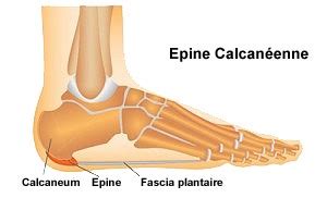 L'épine calcanéenne ou épine de Lenoir | Ortho-Bionomy,Hypnose,Sophrologie