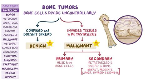 Bone tumors: Pathology review: Video & Anatomy | Osmosis