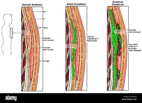 Necrotizing Fasciitis Diagram