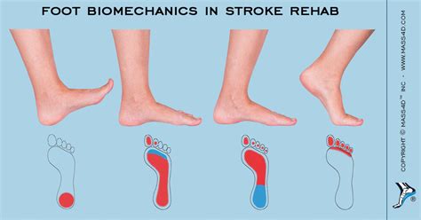 Foot Biomechanics In Stroke Rehab - MASS4D® Foot Orthotics