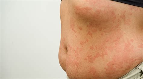 A Quick Overview of Cold Urticaria Symptoms and Treatment