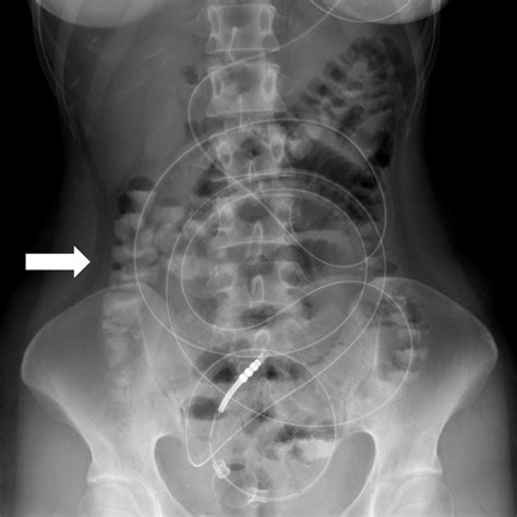 Small Bowel Obstruction Caused by Blood Clots: A Rare Complication of Peptic Ulcer | Mizumura ...