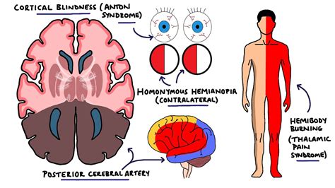 Cerebral Artery Occlusion Pathophysiology - mapasgmaes