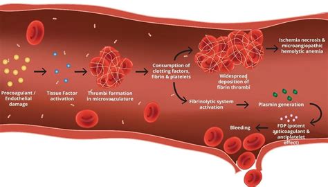 Disseminated Intravascular Coagulation (DIC): An Overview