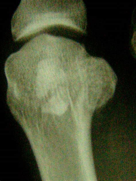 Tibial sesamoid fracture | The Foot and Ankle Online Journal