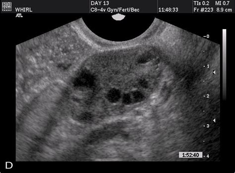 Normal Uterus Transvaginal Ultrasound