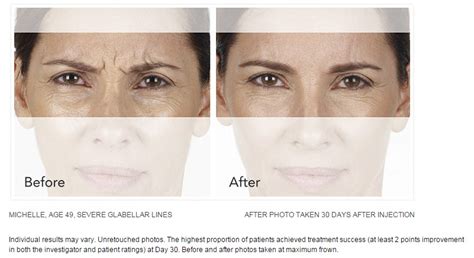 XEOMIN Injections Can Help Reduce Frown Lines | Palm Springs CA Med Spa