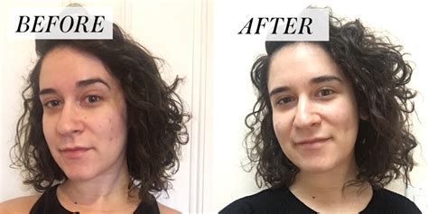 I Stopped Popping My Pimples for a Month - Before and After Photos | Allure