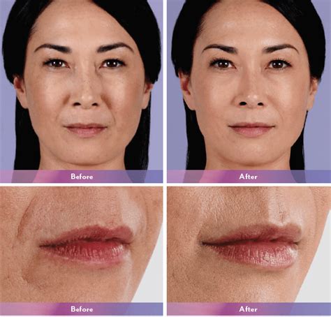 Dermal Fillers | Juvederm, Voluma, Belotero | Newport Med Center