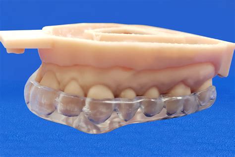 Bite Splints - Classic Craft Dental Lab