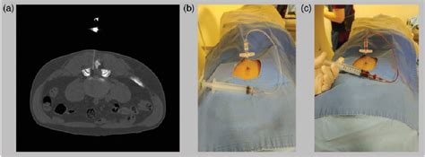 Figure 2 from Treatment of dural tear with nerve root herniation after ...