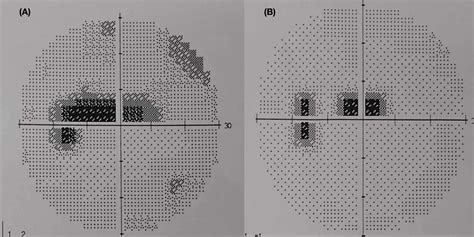 Cureus | Caecocentral Scotoma: A Rare Presentation of Optic Perineuritis