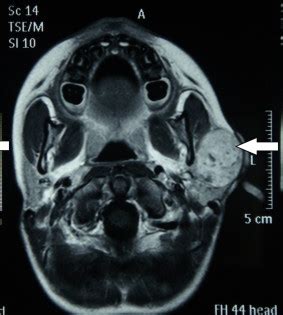 MRI of Parotid gland showing intermediate intensity on T2 weighted... | Download Scientific Diagram