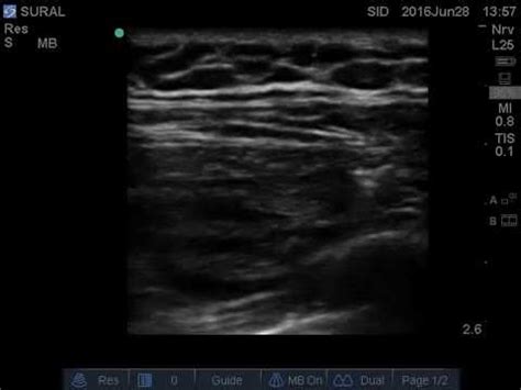 Ultrasound Guided Intercostal Block