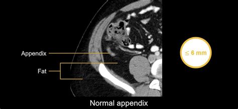 Abdominal CT: appendicitis • LITFL • Radiology Library