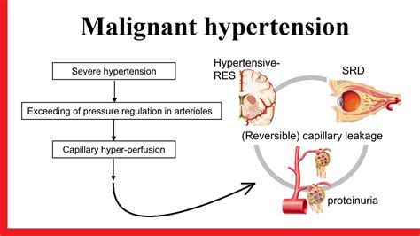 malignant hypertension - YouTube