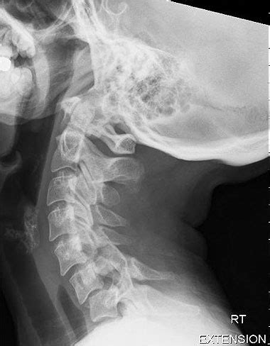 Xray - broken neck | X-Ray | Pinterest