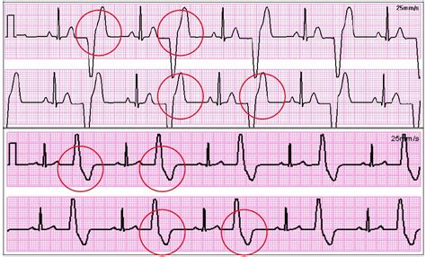 Types Of Pvc Heart Rhythm at Irene Kern blog