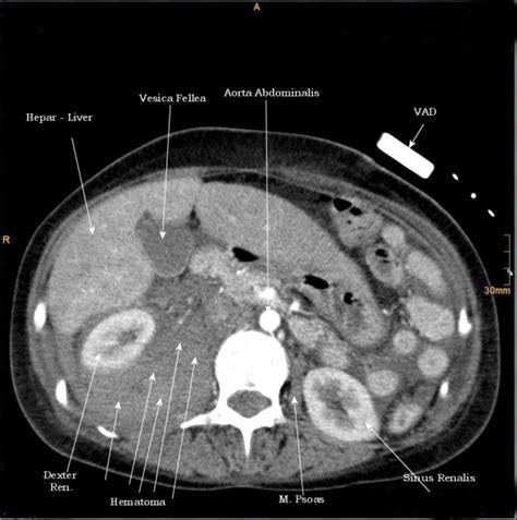 1st case. CT - axial plan demonstrating a retroperitoneal hematoma ...