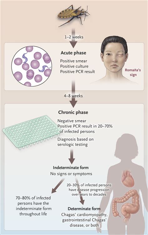 Chagas’ Disease | NEJM