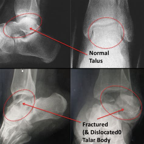 Talus Fracture