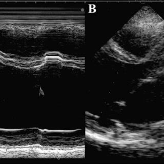 Echocardiography at the age of 27. (1997.1.24) (Panel A) M-mode, (Panel... | Download Scientific ...