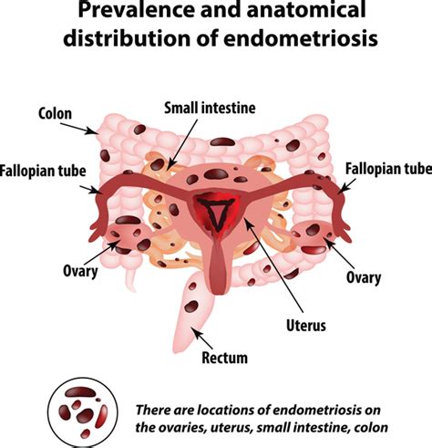 Endometriosis and Diet: What You Can Do About It In 2019 | Diet vs Disease