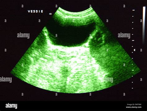 Bladder ultrasound scan Stock Photo - Alamy