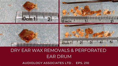 DRY EAR WAX REMOVALS & PERFORATED EARDRUM - EP 210 - YouTube