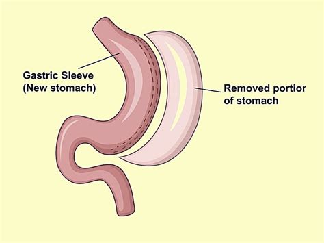 Laparoscopic Sleeve Gastrectomy: Good Operation, With Limits