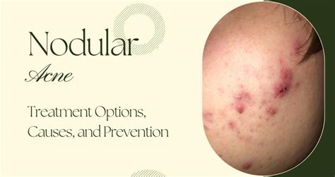 Skin Nodule Acne