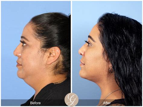 Neck Liposuction Before & After Photos Patient 01 | Dr Kevin Sadati