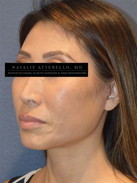 Beverly Hills Facelift Before and After Photos - Los Angeles Plastic ...