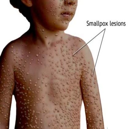 Symptoms Of Smallpox | Medical knowledge, Nursing crib, Nurses station