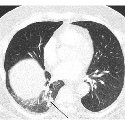 Right lower lobe wedge resection gross surgical specimen: the solid ...